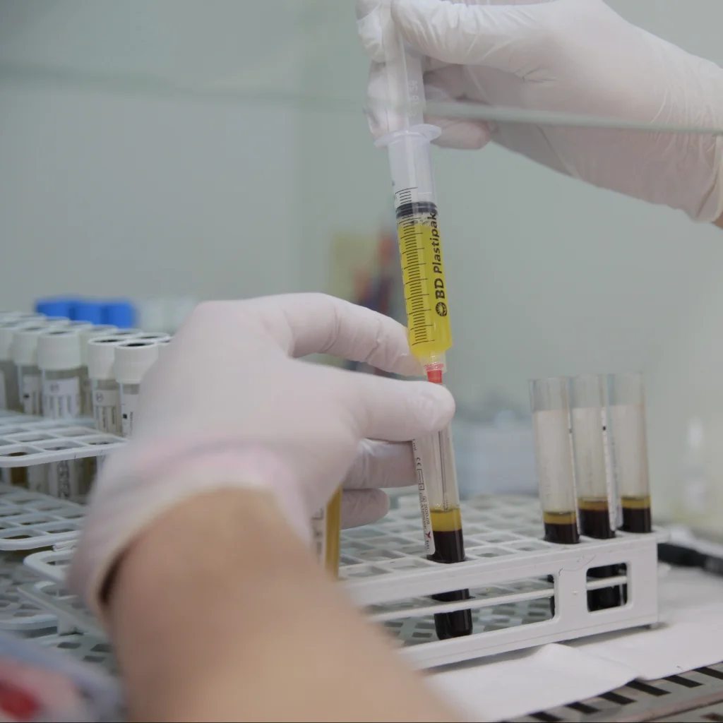 Close-up of a specialist preparing platelet-rich plasma (PRP) samples in the Regenerative Medicine Unit at Instituto Cugat Romania, showing precision in biological therapy processing.
